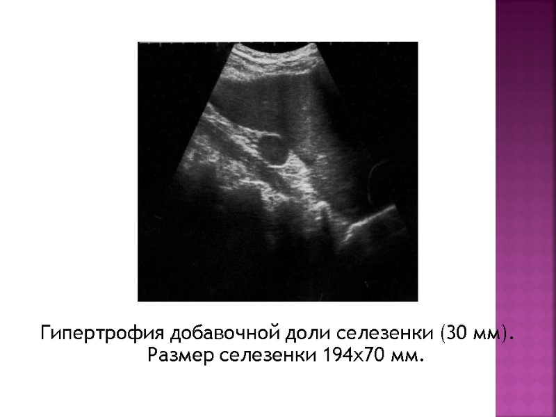 Гипертрофия добавочной доли селезенки (30 мм). Размер селезенки 194х70 мм.